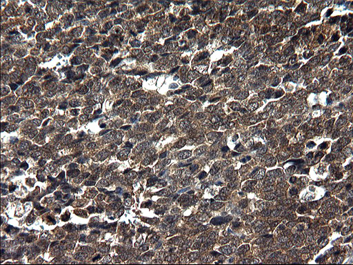 SCRN1 / Secernin 1 Antibody - IHC of paraffin-embedded Adenocarcinoma of Human colon tissue using anti-SCRN1 mouse monoclonal antibody. (Heat-induced epitope retrieval by 1 mM EDTA in 10mM Tris, pH8.5, 120°C for 3min).