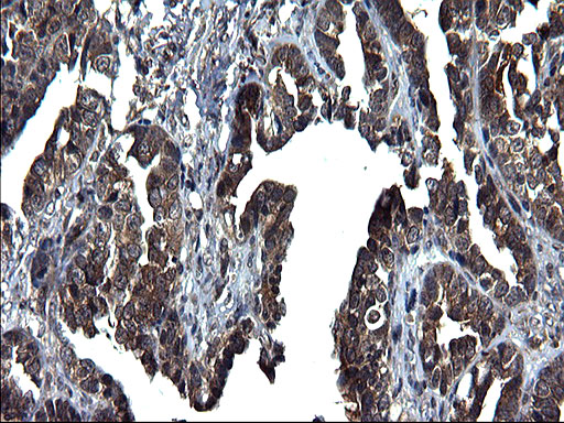 SCRN1 / Secernin 1 Antibody - IHC of paraffin-embedded Adenocarcinoma of Human ovary tissue using anti-SCRN1 mouse monoclonal antibody. (Heat-induced epitope retrieval by 1 mM EDTA in 10mM Tris, pH8.5, 120°C for 3min).