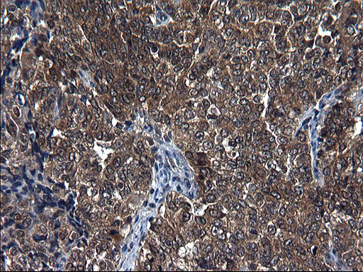 SCRN1 / Secernin 1 Antibody - IHC of paraffin-embedded Adenocarcinoma of Human endometrium tissue using anti-SCRN1 mouse monoclonal antibody. (Heat-induced epitope retrieval by 1 mM EDTA in 10mM Tris, pH8.5, 120°C for 3min).
