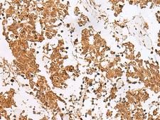 SCRN2 / Ses2 Antibody - Immunohistochemistry of paraffin-embedded Human lung cancer tissue  using SCRN2 Polyclonal Antibody at dilution of 1:60(×200)