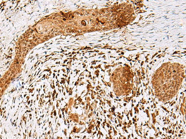 SCRN2 / Ses2 Antibody - Immunohistochemistry of paraffin-embedded Human esophagus cancer tissue  using SCRN2 Polyclonal Antibody at dilution of 1:50(×200)