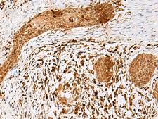 SCRN2 / Ses2 Antibody - Immunohistochemistry of paraffin-embedded Human esophagus cancer tissue  using SCRN2 Polyclonal Antibody at dilution of 1:50(×200)