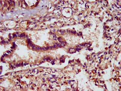 SCUBE2 Antibody - Immunohistochemistry image at a dilution of 1:400 and staining in paraffin-embedded human lung tissue performed on a Leica BondTM system. After dewaxing and hydration, antigen retrieval was mediated by high pressure in a citrate buffer (pH 6.0) . Section was blocked with 10% normal goat serum 30min at RT. Then primary antibody (1% BSA) was incubated at 4 °C overnight. The primary is detected by a biotinylated secondary antibody and visualized using an HRP conjugated SP system.