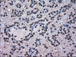 SCYL3 Antibody - IHC of paraffin-embedded Carcinoma of kidney tissue using anti-SCYL3 mouse monoclonal antibody. (Dilution 1:50).