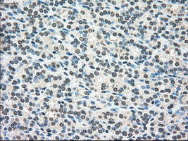 SCYL3 Antibody - IHC of paraffin-embedded Carcinoma of thyroid tissue using anti-SCYL3 mouse monoclonal antibody. (Dilution 1:50).