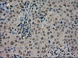 SCYL3 Antibody - IHC of paraffin-embedded Adenocarcinoma of breast tissue using anti-SCYL3 mouse monoclonal antibody. (Dilution 1:50).