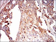 SDC1 / Syndecan 1 / CD138 Antibody - IHC of paraffin-embedded ovarian cancer tissues using SDC1 mouse monoclonal antibody with DAB staining.