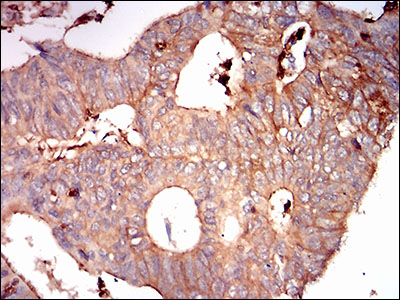 SDC1 / Syndecan 1 / CD138 Antibody - IHC of paraffin-embedded rectum cancer tissues using SDC1 mouse monoclonal antibody with DAB staining.