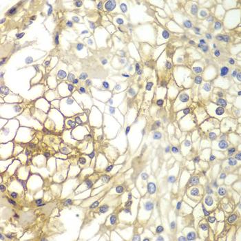 SDC1 / Syndecan 1 / CD138 Antibody - Immunohistochemistry of paraffin-embedded human kidney cancer using SDC1 antibodyat dilution of 1:200 (40x lens).