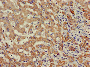 SDC4 / Syndecan 4 Antibody - Immunohistochemistry of paraffin-embedded human liver cancer at dilution of 1:100