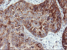 SDCBP / Syntenin Antibody - IHC of paraffin-embedded Adenocarcinoma of Human ovary tissue using anti-SDCBP mouse monoclonal antibody. (Heat-induced epitope retrieval by 10mM citric buffer, pH6.0, 100C for 10min).