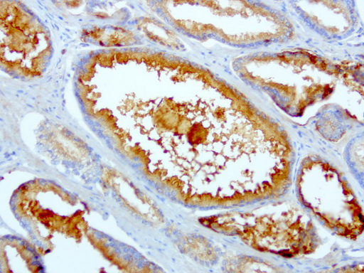 SDCBP / Syntenin Antibody - Immunohistochemical staining of paraffin-embedded human prostate cancer using anti-SDCBP clone UMAB69 mouse monoclonal antibody  at 1:100 with Polink2 Broad HRP DAB detection kit; heat-induced epitope retrieval with GBI Citrate pH6.0 HIER buffer using pressure chamber for 3 minutes at 110C. Membrane and cytoplasmic staining is seen in tumor cells.