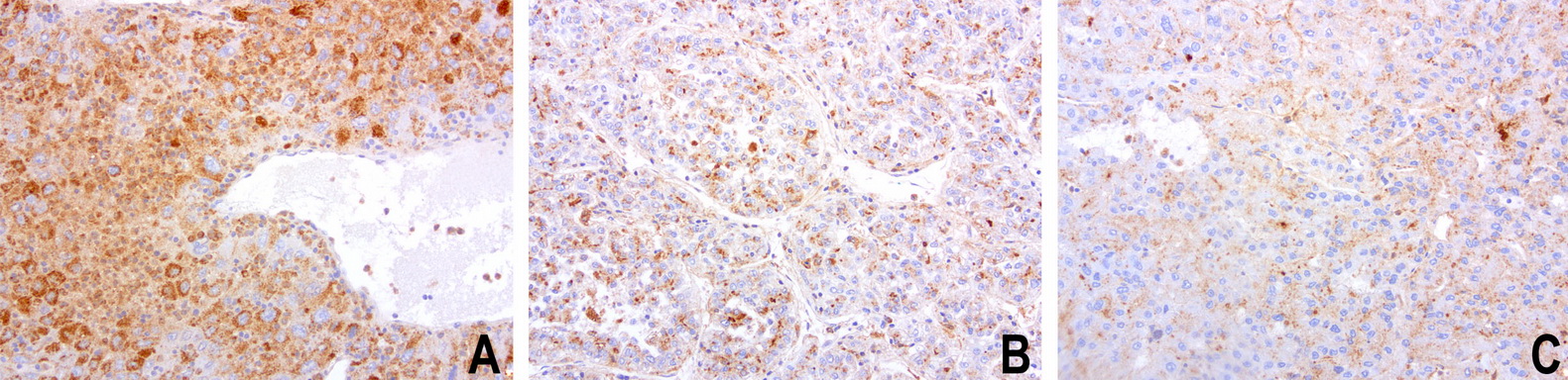 SDCBP / Syntenin Antibody - Immunohistochemical staining of paraffin-embedded composit of 3 human liver cancer cases using anti-SDCBP clone UMAB69 mouse monoclonal antibody  at 1:100 with Polink2 Broad HRP DAB detection kit; heat-induced epitope retrieval with GBI Citrate pH6.0 HIER buffer using pressure chamber for 3 minutes at 110C. Membrane and cytoplasmic staining is seen in tumor cells with various intensity.