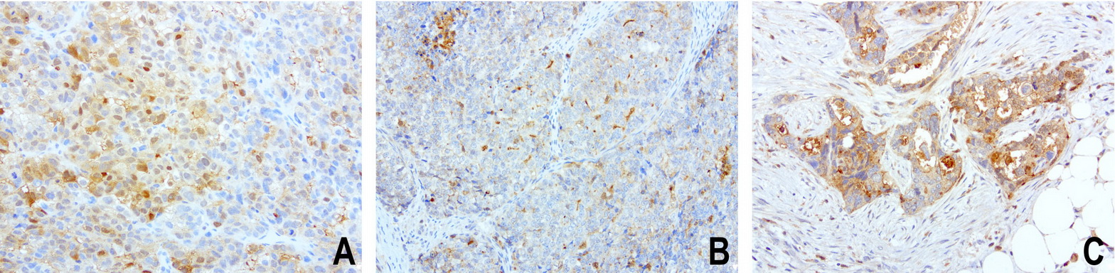 SDCBP / Syntenin Antibody - Immunohistochemical staining of paraffin-embedded composit of 3 human endometrial cancer cases using anti-SDCBP clone UMAB69 mouse monoclonal antibody  at 1:100 with Polink2 Broad HRP DAB detection kit; heat-induced epitope retrieval with GBI Citrate pH6.0 HIER buffer using pressure chamber for 3 minutes at 110C. Membrane and cytoplasmic staining is seen in tumor cells with various intensity.