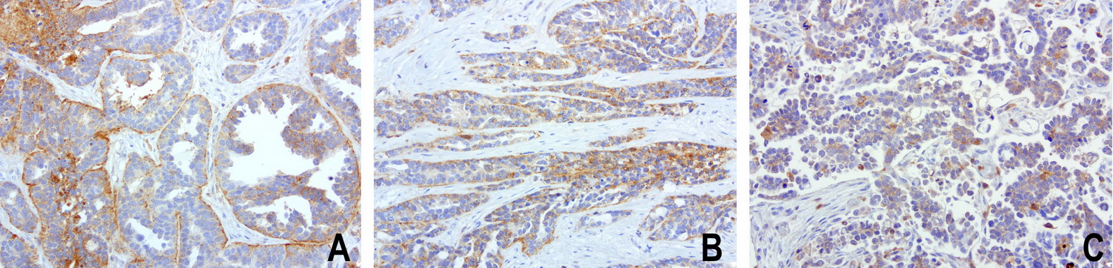 SDCBP / Syntenin Antibody - Immunohistochemical staining of paraffin-embedded composit of 3 human ovarian cancer cases using anti-SDCBP clone UMAB69 mouse monoclonal antibody  at 1:100 with Polink2 Broad HRP DAB detection kit; heat-induced epitope retrieval with GBI Citrate pH6.0 HIER buffer using pressure chamber for 3 minutes at 110C. Membrane and cytoplasmic staining is seen in tumor cells with various intensity.