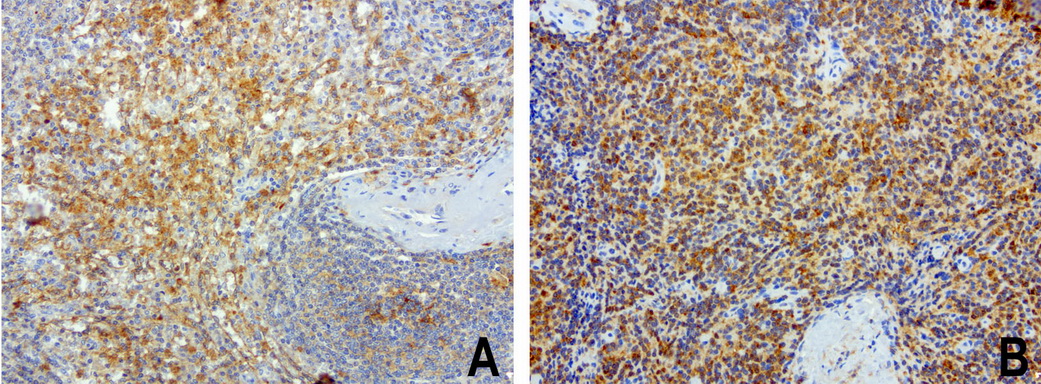SDCBP / Syntenin Antibody - Immunohistochemical staining of paraffin-embedded composit of 2 human spleen cases using anti-SDCBP clone UMAB69 mouse monoclonal antibody  at 1:100 with Polink2 Broad HRP DAB detection kit; heat-induced epitope retrieval with GBI Citrate pH6.0 HIER buffer using pressure chamber for 3 minutes at 110C. Membrane and cytoplasmic staining is seen in the cells of red pulp and white pulp.