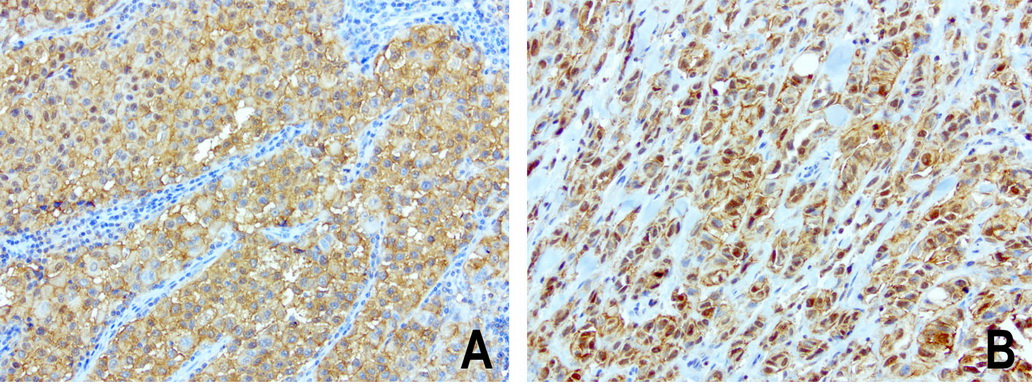 SDCBP / Syntenin Antibody - Immunohistochemical staining of paraffin-embedded composit of 2 human melanoma cases using anti-SDCBP clone UMAB69 mouse monoclonal antibody  at 1:100 with Polink2 Broad HRP DAB detection kit; heat-induced epitope retrieval with GBI Citrate pH6.0 HIER buffer using pressure chamber for 3 minutes at 110C. Membrane, nuclear, and cytoplasmic staining is seen in tumor cells with various intensity.