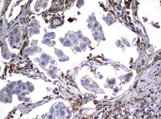 SDCBP / Syntenin Antibody - Immunohistochemical staining of paraffin-embedded Carcinoma of Human bladder tissue using anti-SDCBP mouse monoclonal antibody.  heat-induced epitope retrieval by 10mM citric buffer, pH6.0, 120C for 3min)