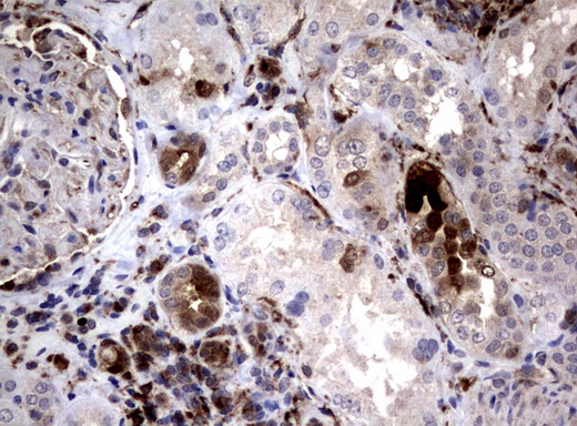 SDCBP / Syntenin Antibody - Immunohistochemical staining of paraffin-embedded Human Kidney tissue using anti-SDCBP mouse monoclonal antibody.  heat-induced epitope retrieval by 10mM citric buffer, pH6.0, 120C for 3min)