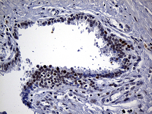 SDCCAG1 / NEMF Antibody - Immunohistochemical staining of paraffin-embedded Carcinoma of Human prostate tissue using anti-NEMF mouse monoclonal antibody. (Heat-induced epitope retrieval by 1mM EDTA in 10mM Tris buffer. (pH8.5) at 120°C for 3 min. (1:250)