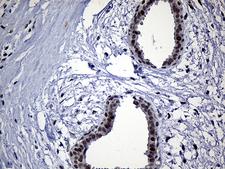 SDCCAG1 / NEMF Antibody - Immunohistochemical staining of paraffin-embedded Human breast tissue within the normal limits using anti-NEMF mouse monoclonal antibody. (Heat-induced epitope retrieval by 1mM EDTA in 10mM Tris buffer. (pH8.5) at 120°C for 3 min. (1:250)