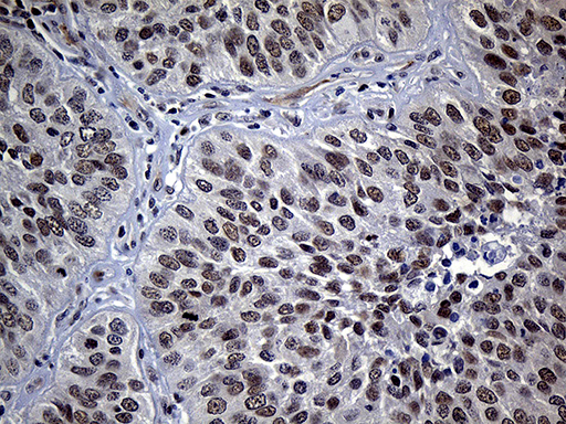 SDCCAG1 / NEMF Antibody - Immunohistochemical staining of paraffin-embedded Carcinoma of Human lung tissue using anti-NEMF mouse monoclonal antibody. (Heat-induced epitope retrieval by 1mM EDTA in 10mM Tris buffer. (pH8.5) at 120°C for 3 min. (1:250)