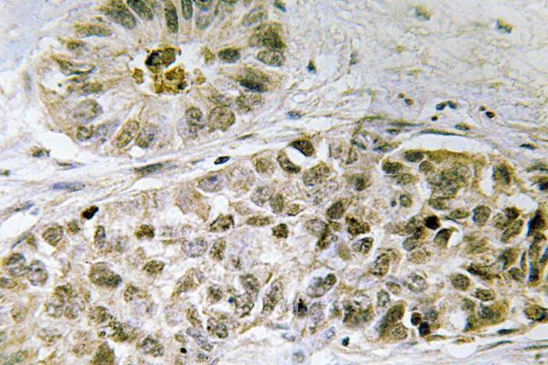 SDCCAG1 / NEMF Antibody - IHC of NY-CO-1 (K914) pAb in paraffin-embedded human lung carcinoma tissue.