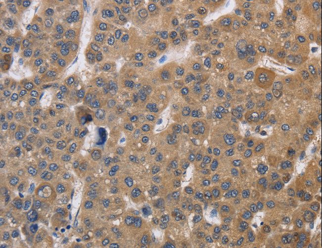 SDCCAG3 Antibody - Immunohistochemistry of paraffin-embedded Human liver cancer using SDCCAG3 Polyclonal Antibody at dilution of 1:30.