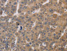 SDCCAG3 Antibody - Immunohistochemistry of paraffin-embedded Human liver cancer using SDCCAG3 Polyclonal Antibody at dilution of 1:30.