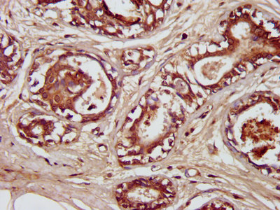 SDCCAG3 Antibody - Immunohistochemistry image at a dilution of 1:300 and staining in paraffin-embedded human breast cancer performed on a Leica BondTM system. After dewaxing and hydration, antigen retrieval was mediated by high pressure in a citrate buffer (pH 6.0) . Section was blocked with 10% normal goat serum 30min at RT. Then primary antibody (1% BSA) was incubated at 4 °C overnight. The primary is detected by a biotinylated secondary antibody and visualized using an HRP conjugated SP system.