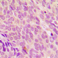 SDCCAG8 Antibody - Immunohistochemical analysis of SDCCAG8 staining in human breast cancer formalin fixed paraffin embedded tissue section. The section was pre-treated using heat mediated antigen retrieval with sodium citrate buffer (pH 6.0). The section was then incubated with the antibody at room temperature and detected using an HRP-conjugated compact polymer system. DAB was used as the chromogen. The section was then counterstained with hematoxylin and mounted with DPX.