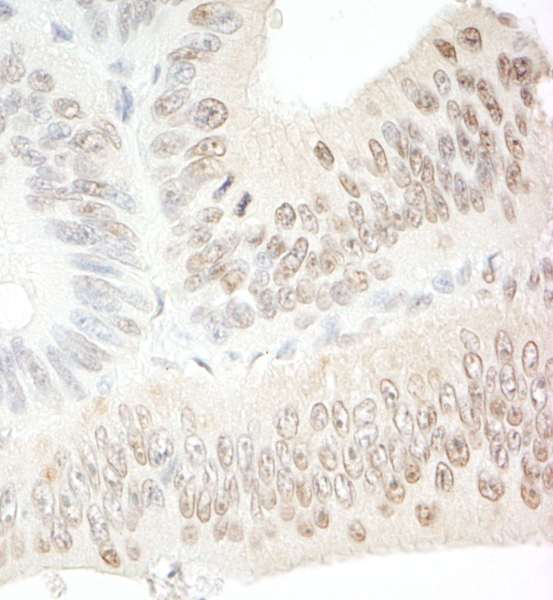 SDE2 / C1orf55 Antibody - Detection of Human C1orf55 by Immunohistochemistry. Sample: FFPE section of human colon carcinoma. Antibody: Affinity purified rabbit anti-C1orf55 used at a dilution of 1:5000 (0.2 ug/ml).