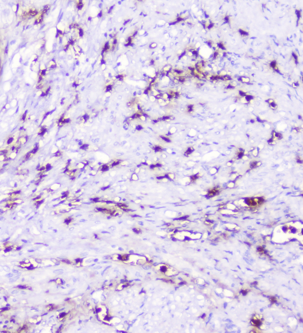 SDF1 / CXCL12 Antibody - IHC analysis of CXCL12 using anti-CXCL12 antibody. CXCL12 was detected in paraffin-embedded section of human endometrial carcinoma tissue. Heat mediated antigen retrieval was performed in citrate buffer (pH6, epitope retrieval solution) for 20 mins. The tissue section was blocked with 10% goat serum. The tissue section was then incubated with 1µg/ml rabbit anti-CXCL12 Antibody overnight at 4°C. Biotinylated goat anti-rabbit IgG was used as secondary antibody and incubated for 30 minutes at 37°C. The tissue section was developed using Strepavidin-Biotin-Complex (SABC) with DAB as the chromogen.