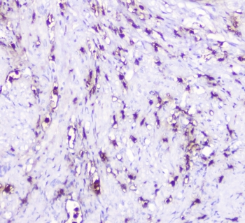 SDF1 / CXCL12 Antibody - IHC staining of FFPE human endometrial carcinoma with CXCL12 antibody at 0.5ug/ml. HIER: boil tissue sections in pH6, 10mM citrate buffer, for 10-20 min followed by cooling at RT for 20 min.