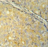 SDHAF1 Antibody - SDHAF1 Antibody immunohistochemistry of formalin-fixed and paraffin-embedded human prostate carcinoma followed by peroxidase-conjugated secondary antibody and DAB staining.