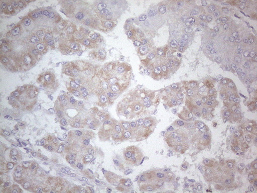 SDHB Antibody - Immunohistochemical staining of paraffin-embedded Carcinoma of Human liver tissue using anti-SDHB mouse monoclonal antibody. (Heat-induced epitope retrieval by 1mM EDTA in 10mM Tris buffer. (pH8.5) at 120°C for 3 min. (1:150)