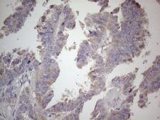 SDHB Antibody - Immunohistochemical staining of paraffin-embedded Adenocarcinoma of Human ovary tissue using anti-SDHB mouse monoclonal antibody. (Heat-induced epitope retrieval by 1mM EDTA in 10mM Tris buffer. (pH8.5) at 120°C for 3 min. (1:150)