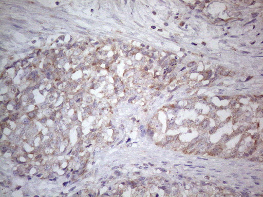 SDHB Antibody - Immunohistochemical staining of paraffin-embedded Adenocarcinoma of Human endometrium tissue using anti-SDHB mouse monoclonal antibody. (Heat-induced epitope retrieval by 1mM EDTA in 10mM Tris buffer. (pH8.5) at 120°C for 3 min. (1:150)