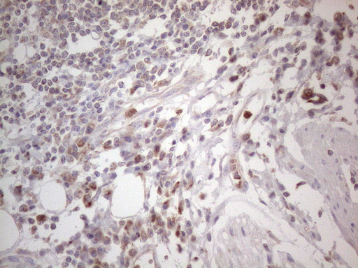 SDHB Antibody - Immunohistochemical staining of paraffin-embedded Adenocarcinoma of Human colon tissue using anti-SDHB mouse monoclonal antibody. (Heat-induced epitope retrieval by 1mM EDTA in 10mM Tris buffer. (pH8.5) at 120°C for 3 min. (1:150)