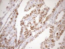 SDHB Antibody - Immunohistochemical staining of paraffin-embedded Carcinoma of Human thyroid tissue using anti-SDHB mouse monoclonal antibody. (Heat-induced epitope retrieval by 1mM EDTA in 10mM Tris buffer. (pH8.5) at 120°C for 3 min. (1:150)