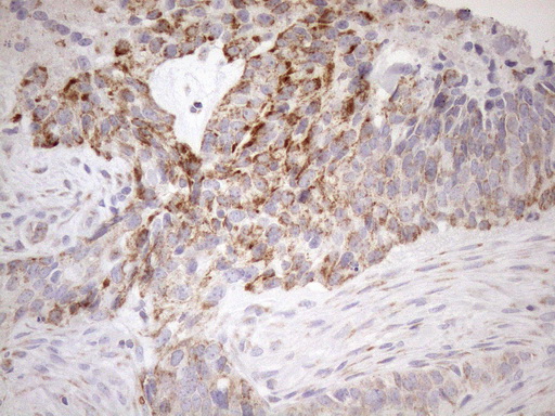 SDHB Antibody - Immunohistochemical staining of paraffin-embedded Adenocarcinoma of Human endometrium tissue using anti-SDHB mouse monoclonal antibody. (Heat-induced epitope retrieval by 1mM EDTA in 10mM Tris buffer. (pH8.5) at 120°C for 3 min. (1:150)