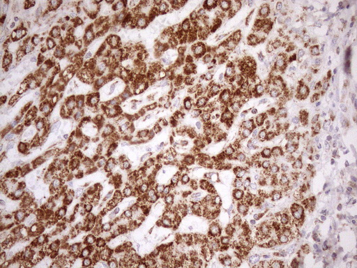 SDHB Antibody - Immunohistochemical staining of paraffin-embedded Carcinoma of Human liver tissue using anti-SDHB mouse monoclonal antibody. (Heat-induced epitope retrieval by 1mM EDTA in 10mM Tris buffer. (pH8.5) at 120°C for 3 min. (1:150)