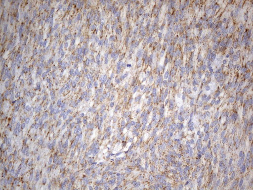 SDHB Antibody - Immunohistochemical staining of paraffin-embedded Human gastric stromal tumor tissue using anti-SDHB mouse monoclonal antibody. (Heat-induced epitope retrieval by 1mM EDTA in 10mM Tris buffer. (pH8.0) at 120°C for 2.5 min. (1:300)