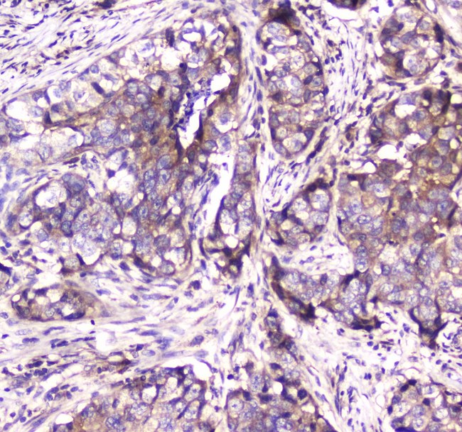 SDHB Antibody - IHC analysis of SDHB using anti-SDHB antibody. SDHB was detected in paraffin-embedded section of human mammary cancer tissue. Heat mediated antigen retrieval was performed in citrate buffer (pH6, epitope retrieval solution) for 20 mins. The tissue section was blocked with 10% goat serum. The tissue section was then incubated with 1µg/ml rabbit anti-SDHB Antibody overnight at 4°C. Biotinylated goat anti-rabbit IgG was used as secondary antibody and incubated for 30 minutes at 37°C. The tissue section was developed using Strepavidin-Biotin-Complex (SABC) with DAB as the chromogen.