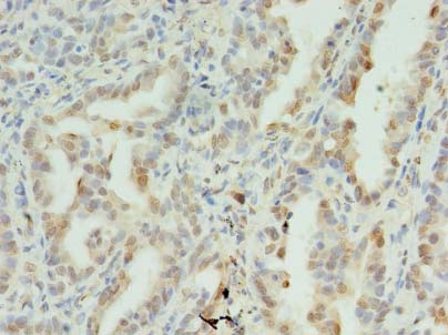 SDHC Antibody - Immunohistochemistry of paraffin-embedded human lung cancer using antibody at dilution of 1:100.