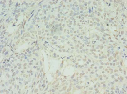 SDHC Antibody - Immunohistochemistry of paraffin-embedded human breast cancer using antibody at dilution of 1:100.