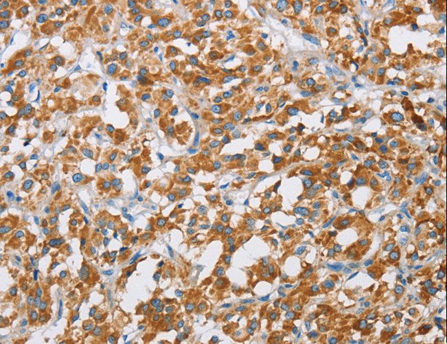 SDR9C1 / BDH1 Antibody - Immunohistochemistry of paraffin-embedded Human liver cancer using BDH1 Polyclonal Antibody at dilution of 1:60.
