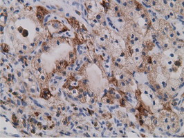 SDR9C7 Antibody - IHC of paraffin-embedded Carcinoma of Human kidney tissue using anti-SDR9C7 mouse monoclonal antibody.