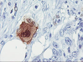 SDS Antibody - IHC of paraffin-embedded Carcinoma of Human pancreas tissue using anti-SDS mouse monoclonal antibody.
