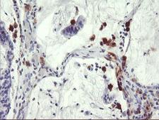 SDS Antibody - IHC of paraffin-embedded Adenocarcinoma of Human colon tissue using anti-SDS mouse monoclonal antibody.